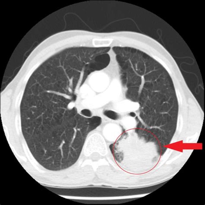 Can scar tissue look like a mass on a CT scan?