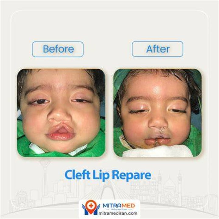 Cleft Lip and Palate Repair Johns Hopkins Facial Plastic and