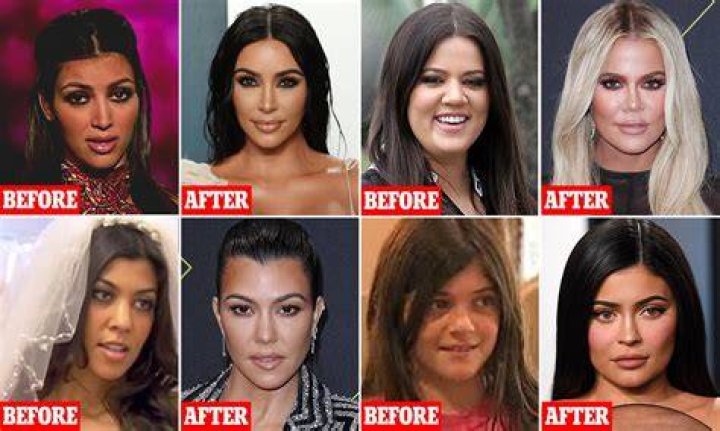 Daily Scoop The Kardashians Before and After Surgery