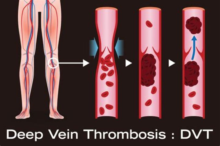 Deep vein thrombosis The Vein Lab