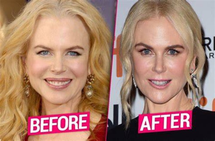 Did Nicole Kidman Have Facelift & Lip Augmentation?