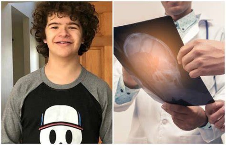 Displasia Cleidocraneal, enfermedad que padece Gaten Matarazzo La