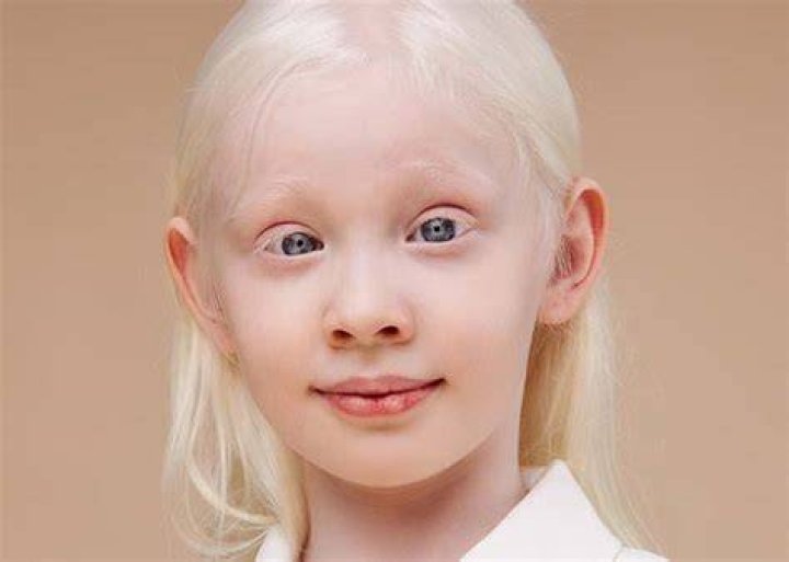 Do albinos have mental problems?