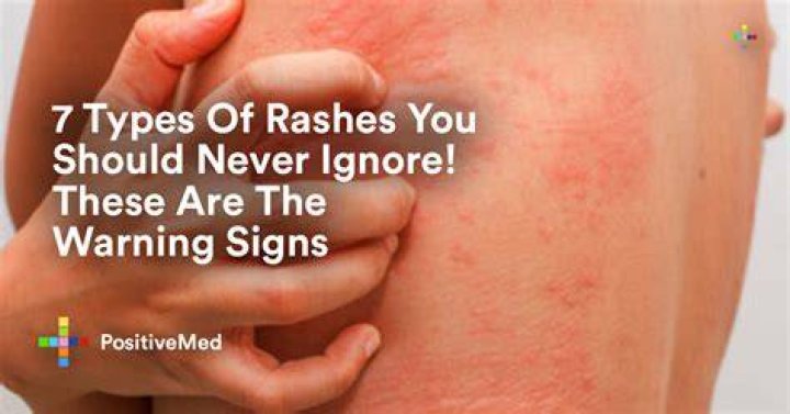 How do you get rid of a rash that won't go away?