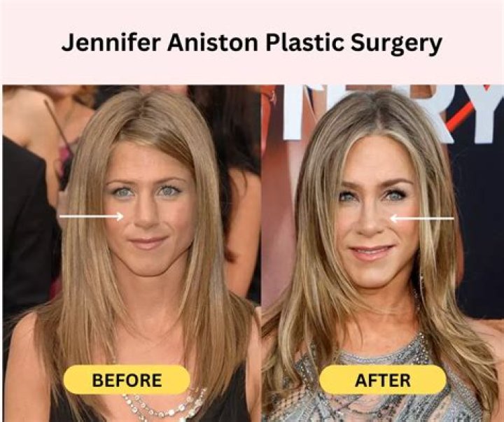 Jennifer Aniston Plastic Surgery Before and After Pictures