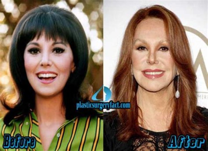 Marlo Thomas Plastic Surgery Diversity News Magazine