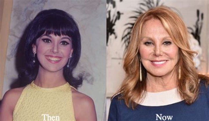 Marlo Thomas Plastic Surgery Facelift, Eyelid Surgery, Teeth Veneer