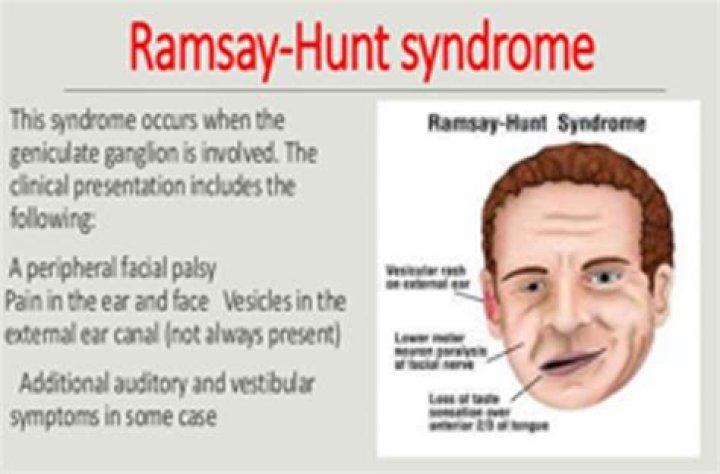 My Battle with Ramsay Hunt Syndrome (The First Year)
