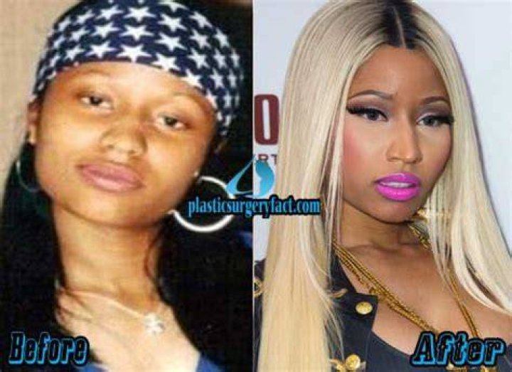 Nicki Minaj Before And After Skin Bleaching