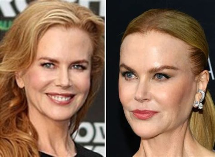 Nicole Kidman&rsquo;s Plastic Surgery Transformation Top Docs Claim