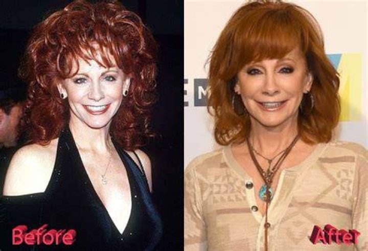 Reba McEntire Plastic Surgery Did She Undergo Surgery?