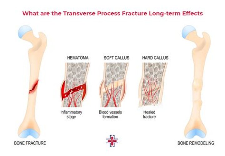 Transverse fracture symptoms, causes and treatment (2023)