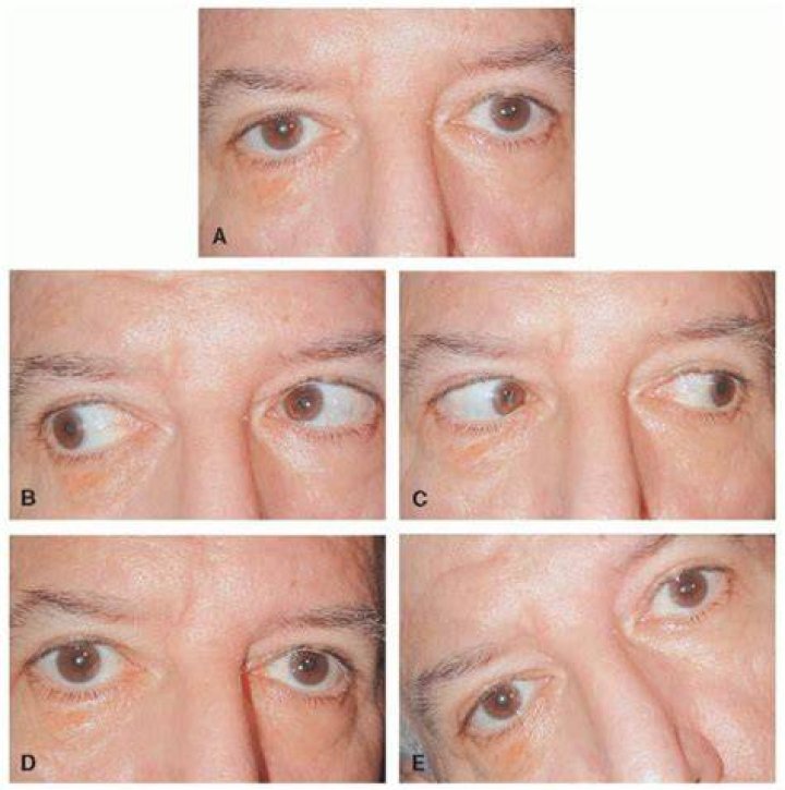 What is gaze misalignment?